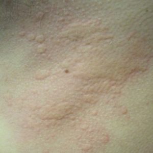 Allergi – fiks inneklimaet